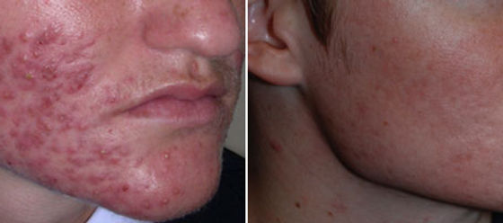 Roaccutane gel acheter ligne