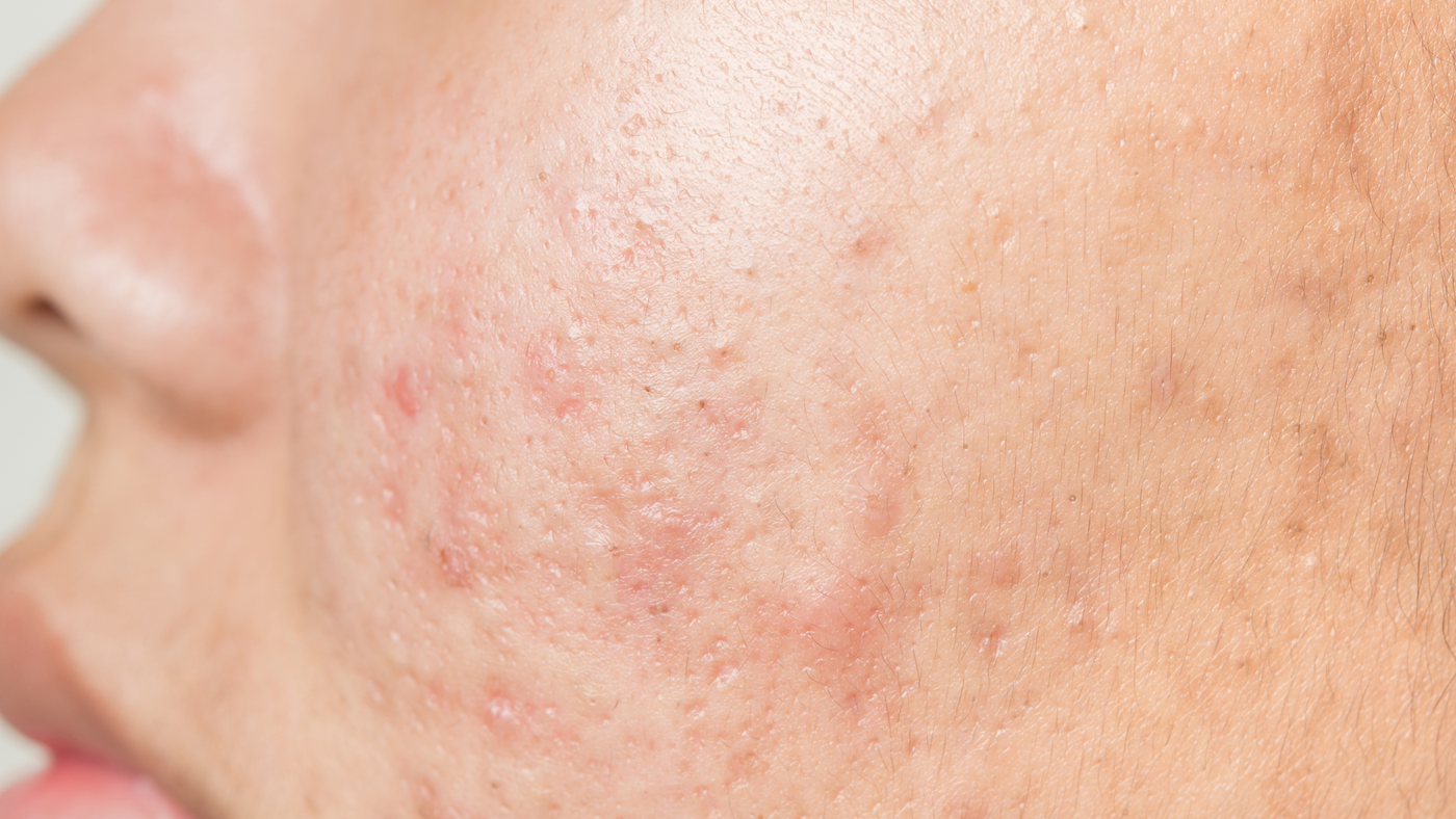Prix Traitement Roaccutane
