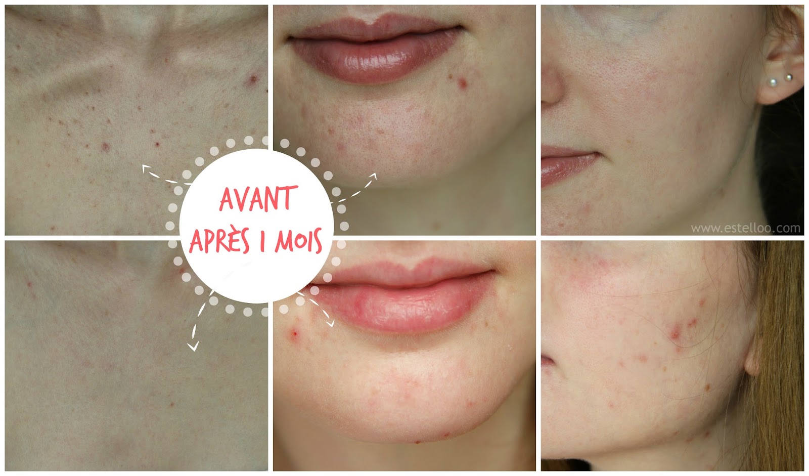 Comment acheter du roaccutane