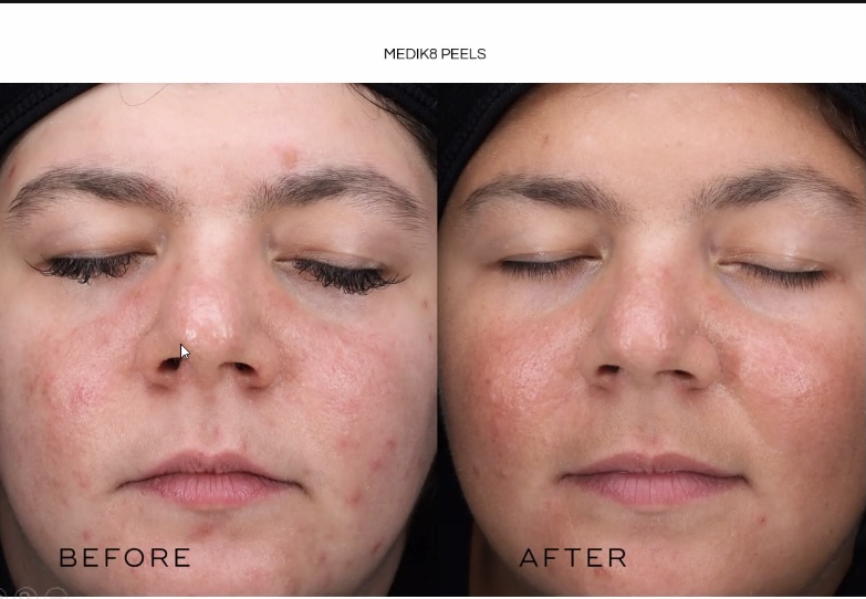 roaccutane prix 2020