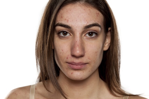 Roaccutane comprimé prix