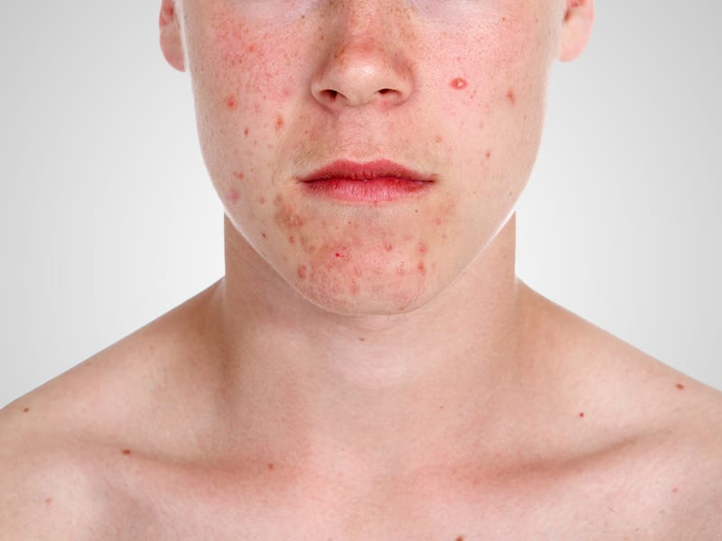Roaccutane achat en ligne