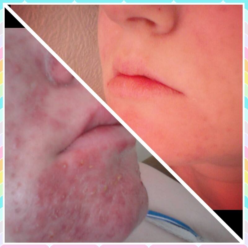isotretinoin gel online
