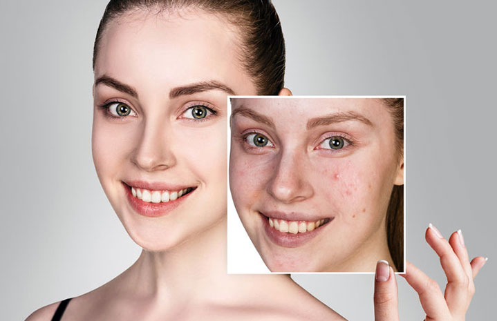 Achat roaccutane en ligne