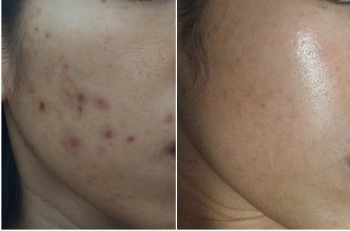 Roaccutane Gel Achat En Ligne