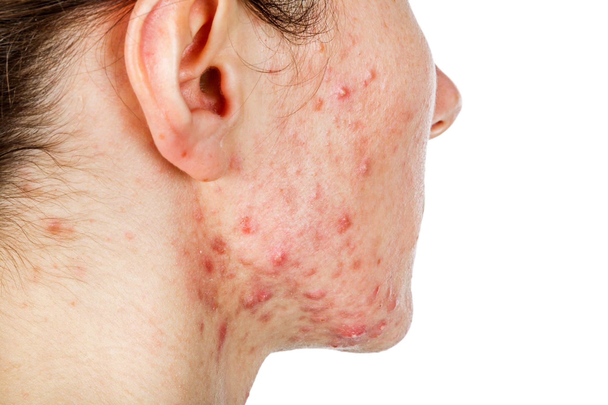 Roaccutane achat en ligne