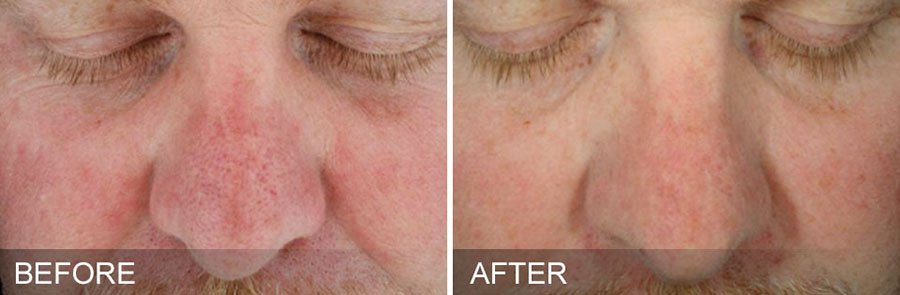 prix traitement roaccutane