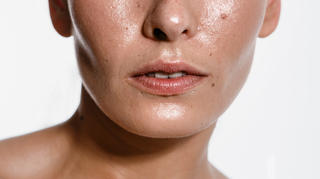 Roaccutane Acheter Ligne