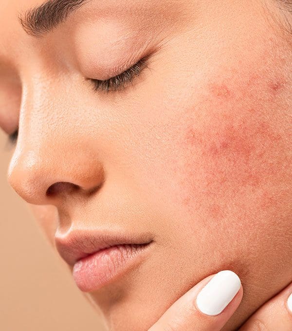 Accutane prix
