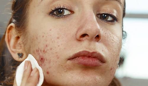 isotretinoin pilule
