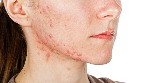 Ordre accutane
