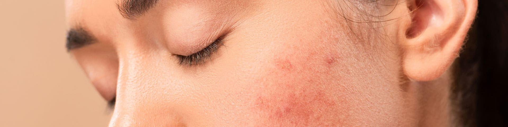 Prix pour roaccutane