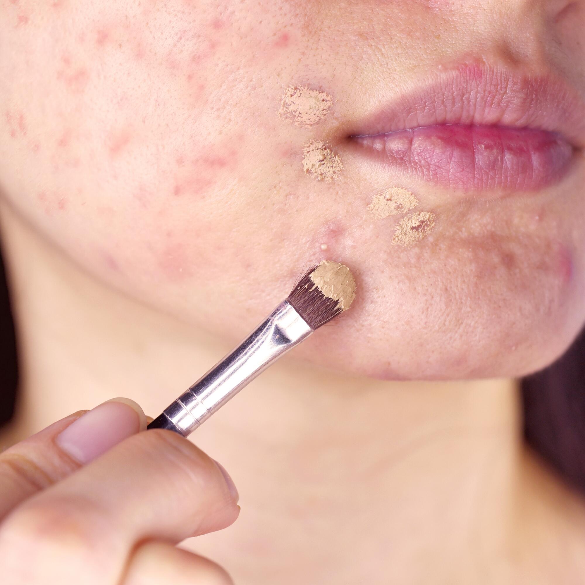 Roaccutane achat en ligne