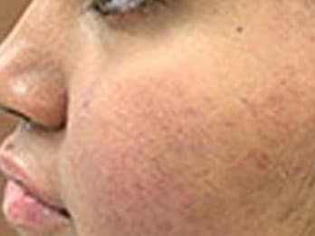 Roaccutane pharmacie online
