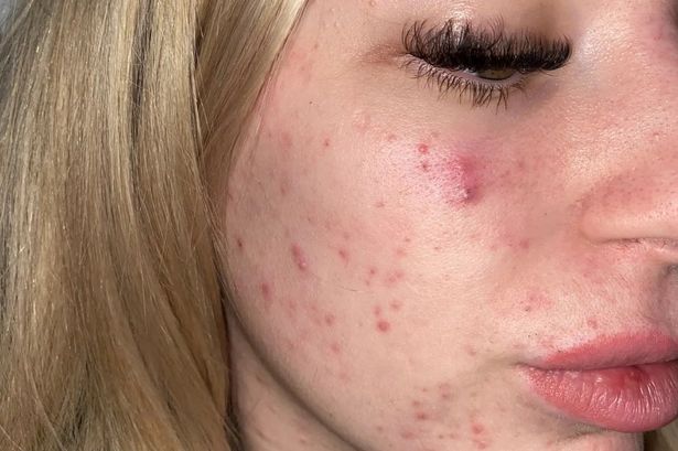 Roaccutane prix 2020
